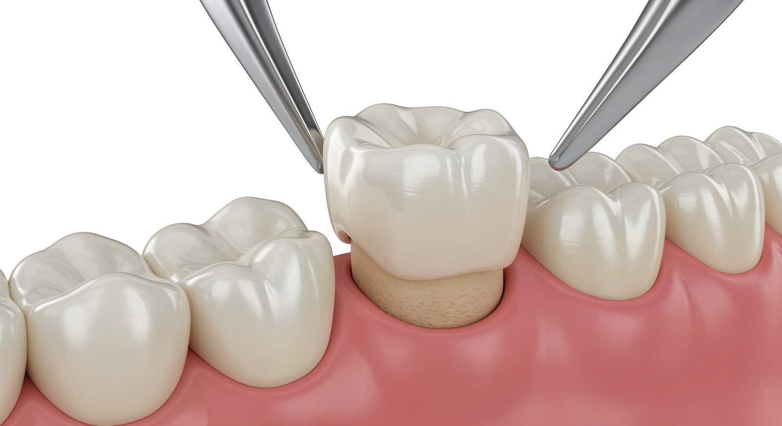 Dental Crowns